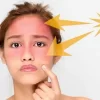 درمان سریع آفتاب سوختگی صورت