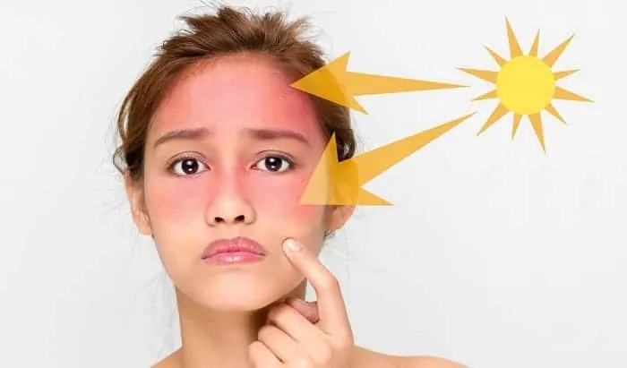 درمان سریع آفتاب سوختگی صورت