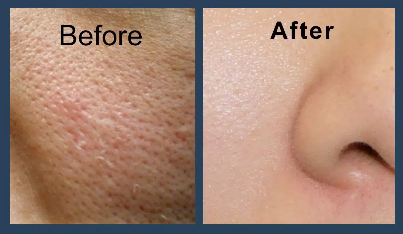 درمان قطعی منافذ باز پوست
